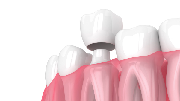 Dental Crowns