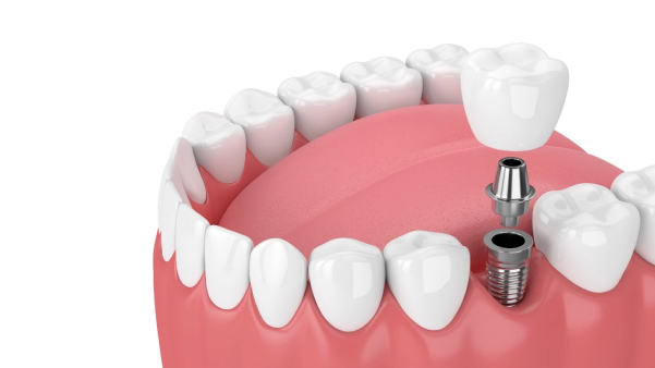 Dental Implants