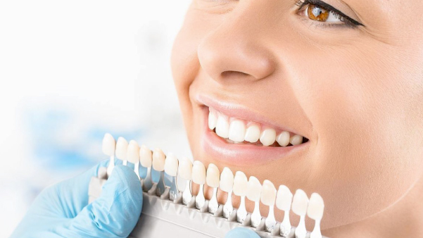 Veneers