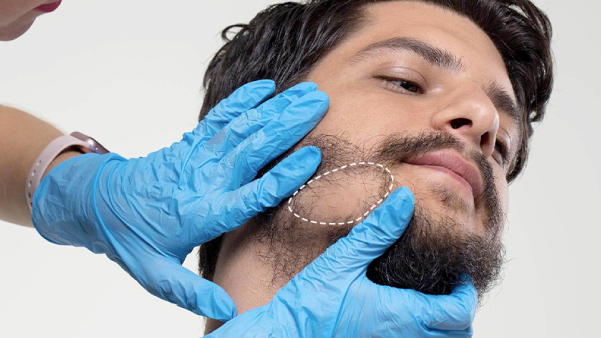 Beard Transplant