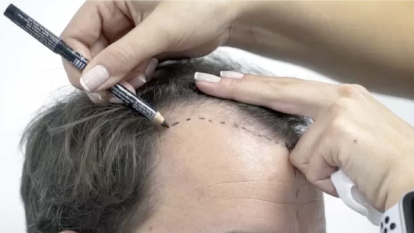 FUE Hair Transplant