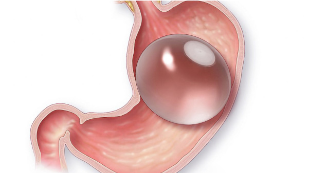 Gastric Balloon