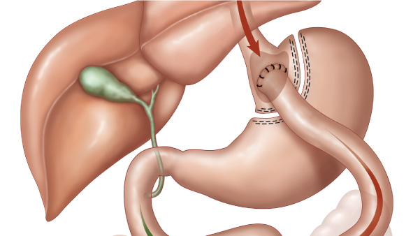 Gastric Bypass