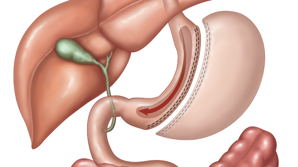 Gastric Sleeve
