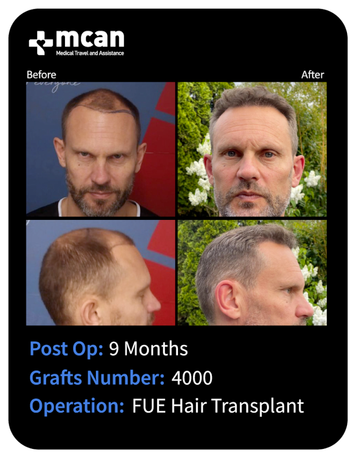 before after 10