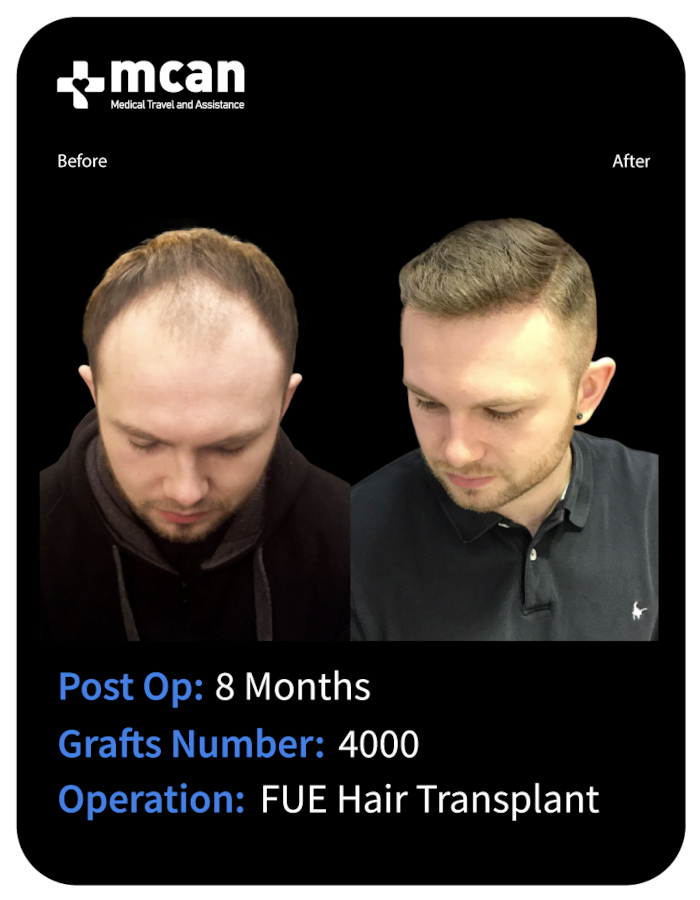 before after 11
