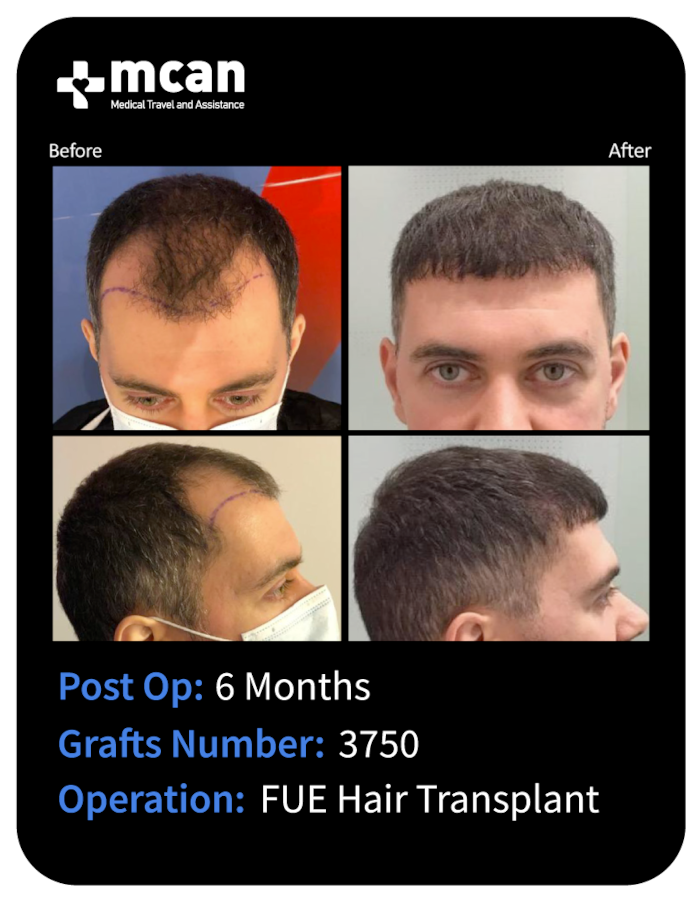 before after 12