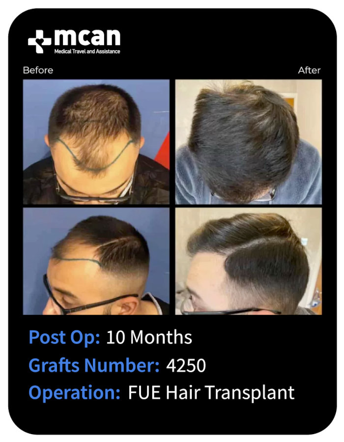 before after 15