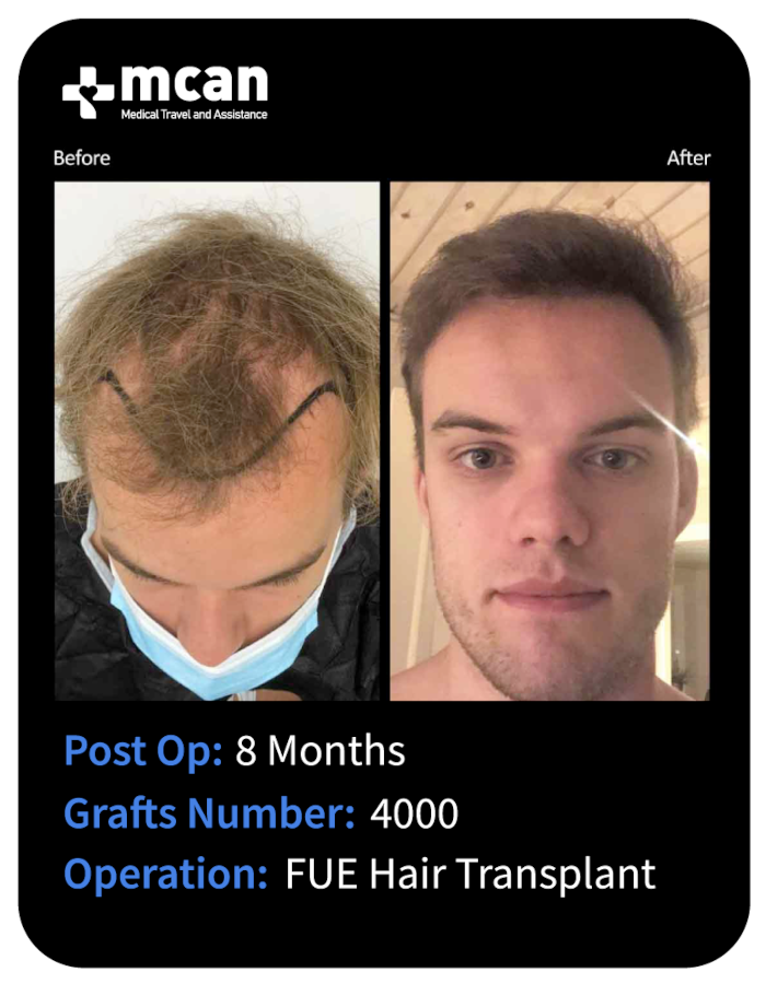 before after 17