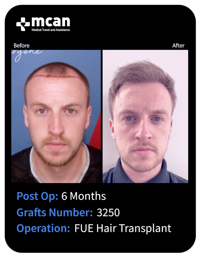 before after 20