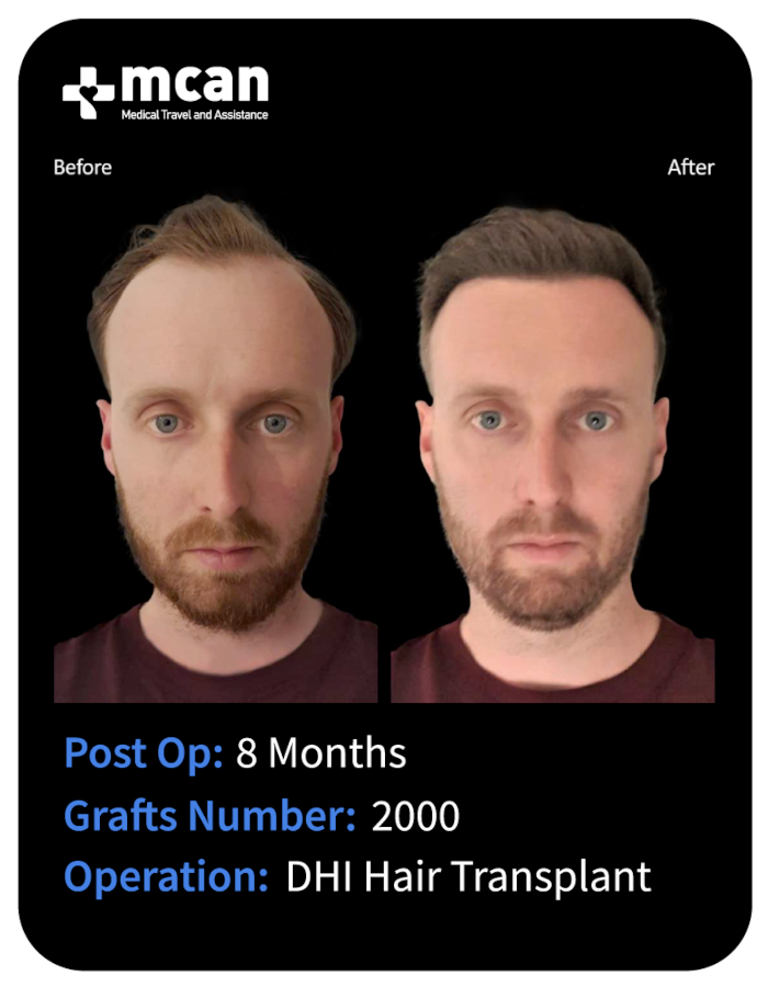 before after 22