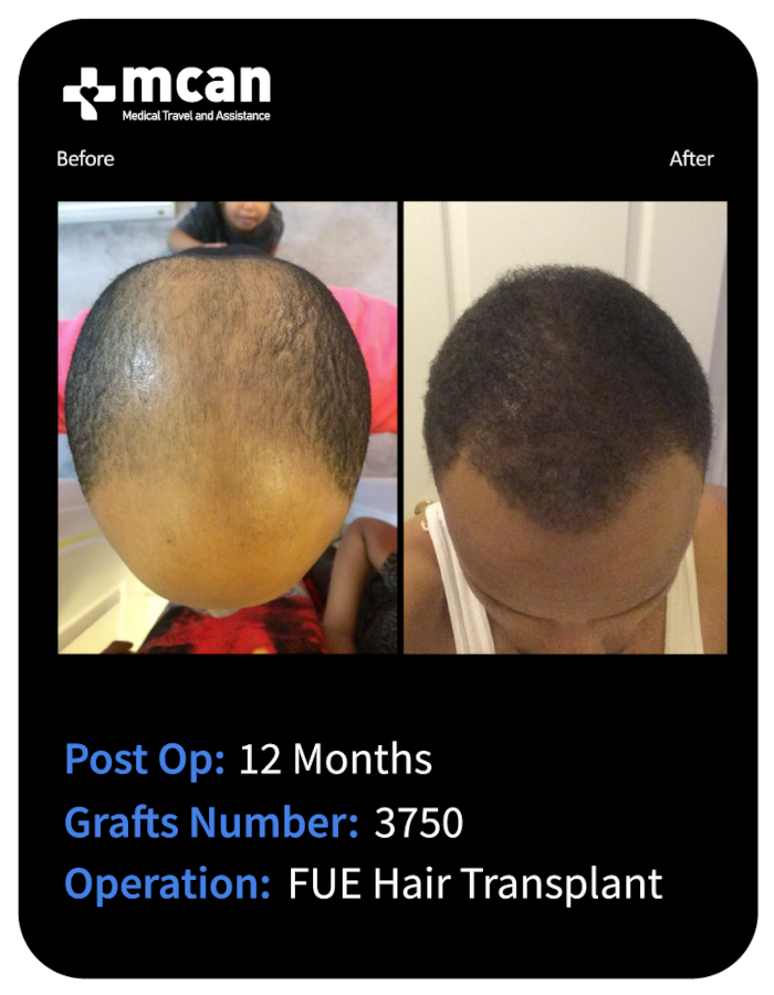 before after 23