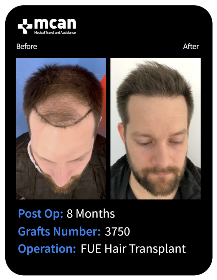 before after 28