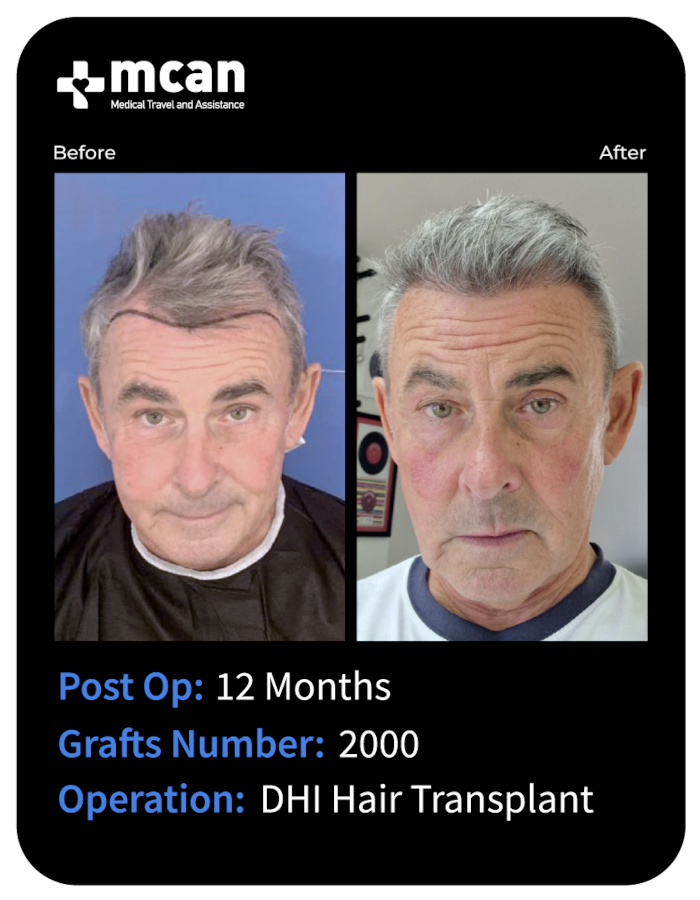 before after 4
