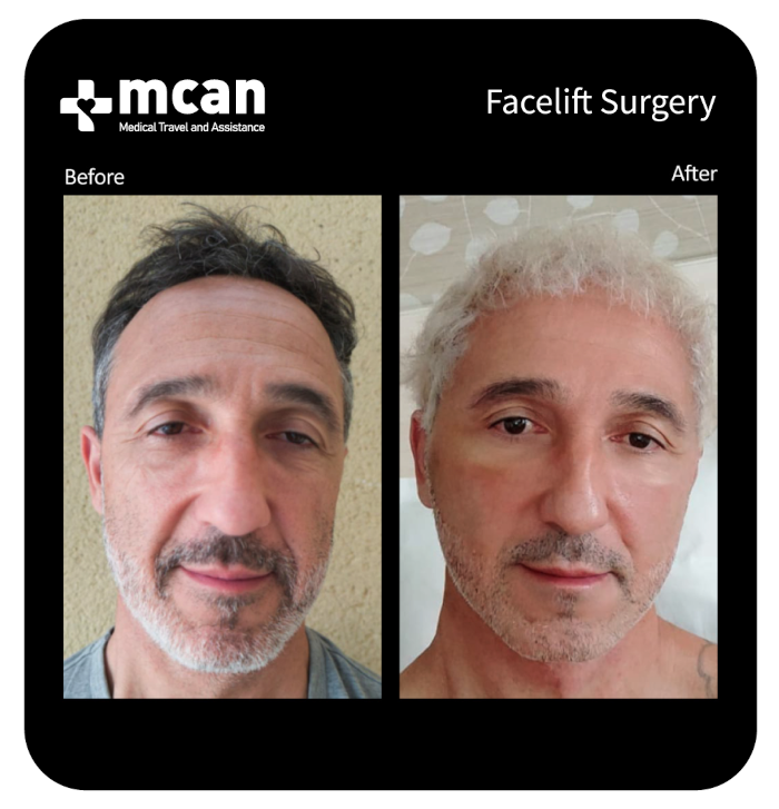 before after