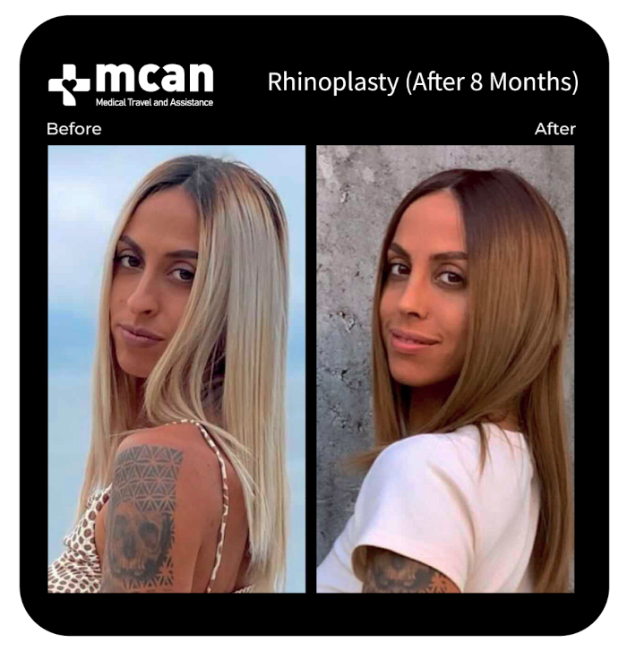 before after